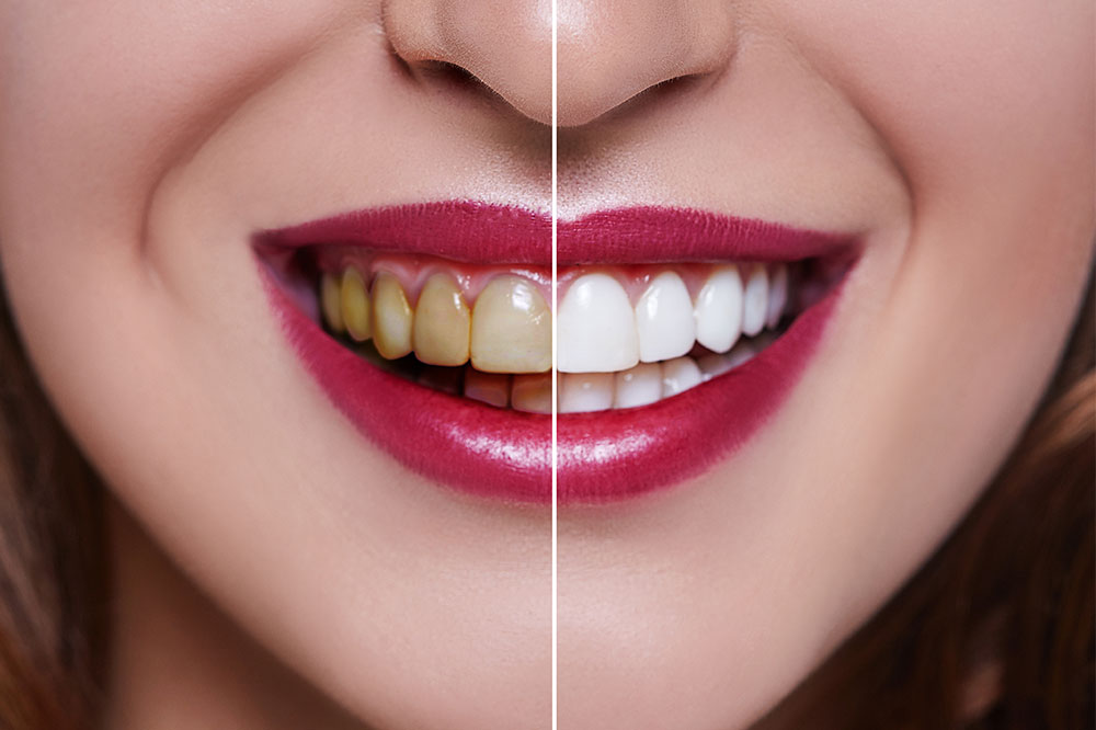 Dental veneers&#8217; cost, procedure, and results