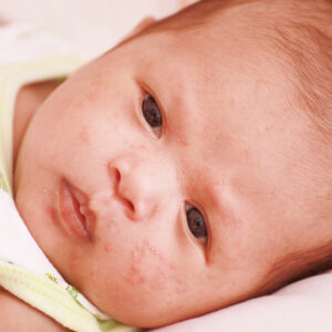 Atopic dermatitis in infants &#8211; Signs and management tips