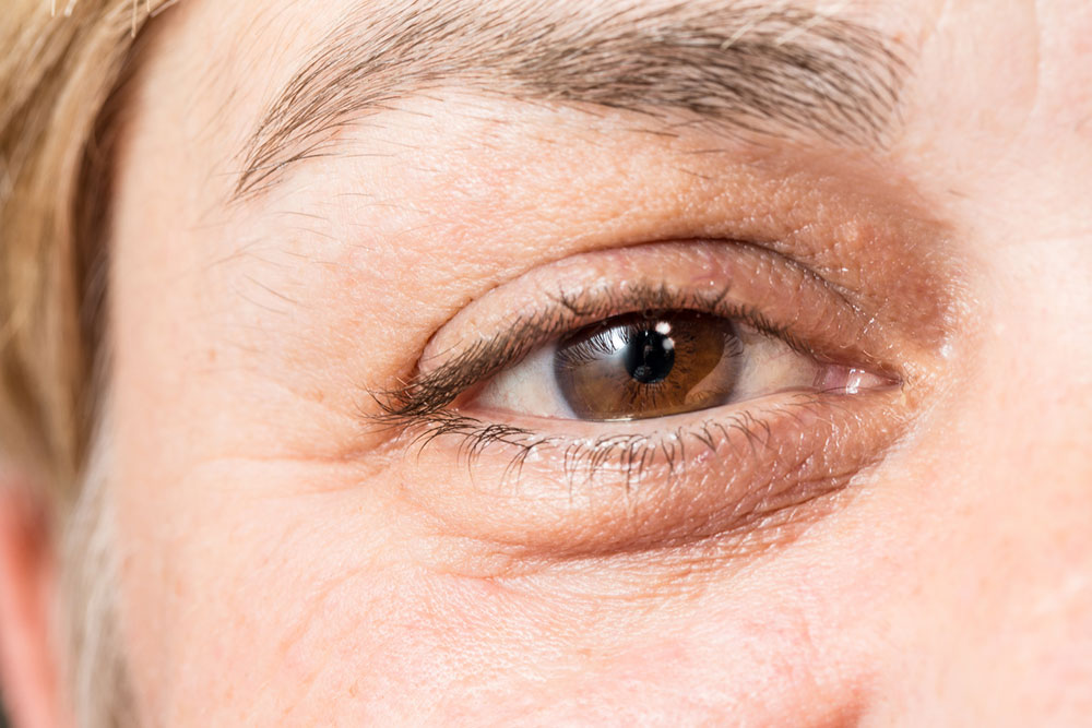 Causes, symptoms, and management of thyroid eye disease